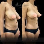 Результаты до и после mommy makeover в Alexandre Aguilera – коррекция тела и груди