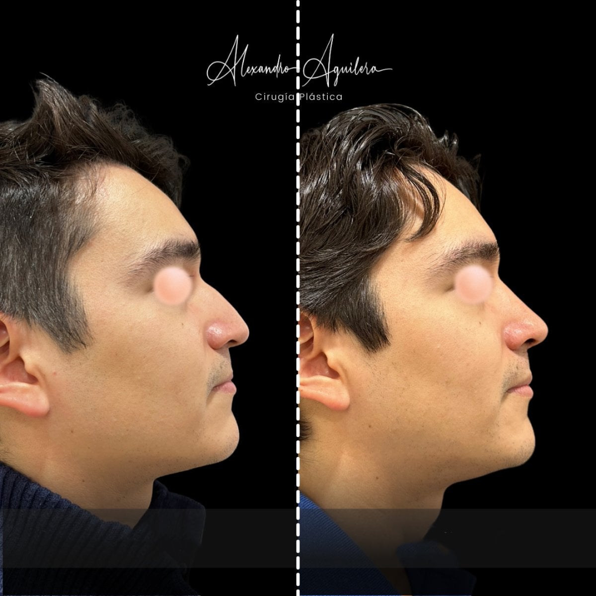 نتائج قبل وبعد تجميل الأنف بالموجات فوق الصوتية في عيادة Alexandre Aguilera