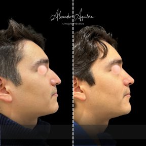 Vorher-nachher-Ergebnisse der Ultraschall-Rhinoplastik in der Klinik Alexandre Aguilera