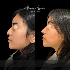 Vorher-nachher-Ergebnis der Ultraschall-Rhinoplastik bei Alexandre Aguilera, Nasenkorrektur