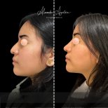 Vorher-nachher-Ergebnis der Ultraschall-Rhinoplastik bei Alexandre Aguilera, Nasenkorrektur