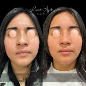 Vorher-nachher-Ergebnisse der Ultraschall-Rhinoplastik in der Klinik Alexandre Aguilera