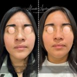 Vorher-nachher-Ergebnisse der Ultraschall-Rhinoplastik in der Klinik Alexandre Aguilera