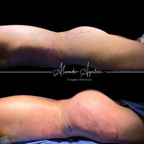 Vorher-nachher-Ergebnis Brazilian Butt Lift in der Klinik Alexandre Aguilera, verbesserte Kurven