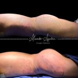 Vorher-nachher-Ergebnis Brazilian Butt Lift in der Klinik Alexandre Aguilera, verbesserte Kurven