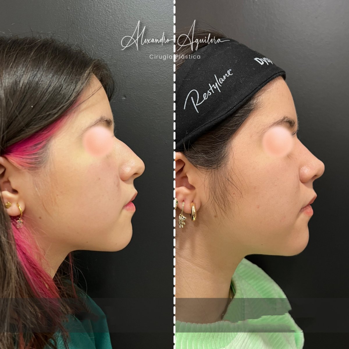 Resultado de rinoplastia antes y después en clínica Alexandre Aguilera, perfil nasal mejorado