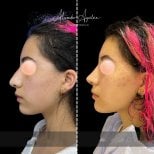 Before and after rhinoplasty results at Alexandre Aguilera, nose reshaping for natural look