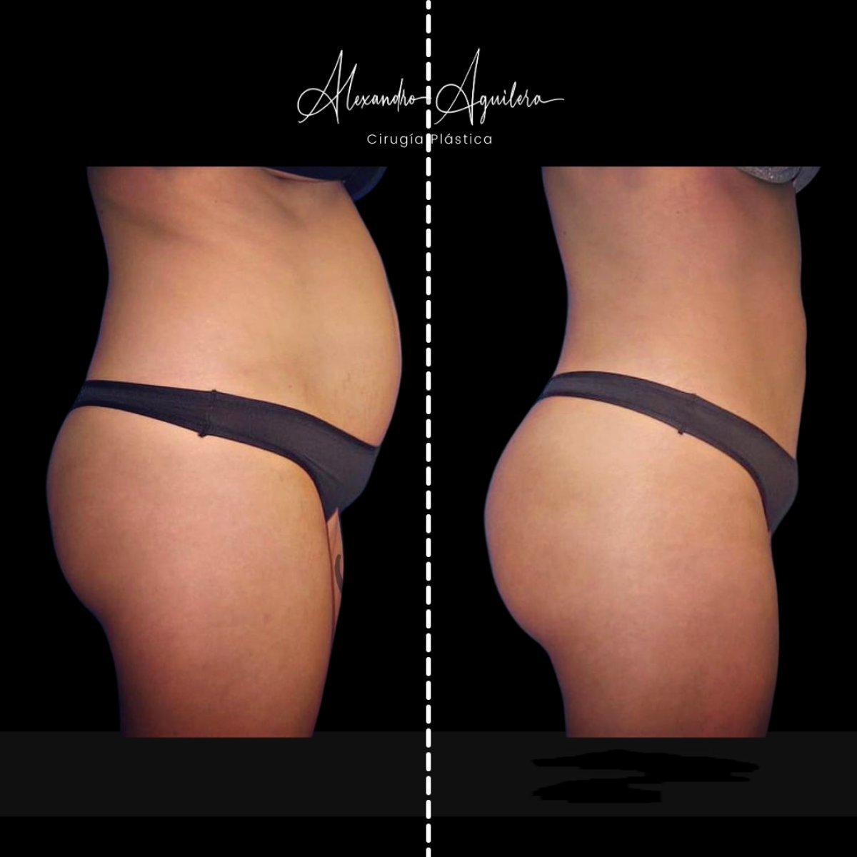 Resultados de lipofilling antes y después en Alexandre Aguilera, contorno corporal mejorado