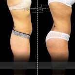 Before and after butt implants at Alexandre Aguilera clinic – enhanced gluteal contour result