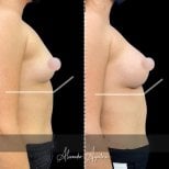 Результаты до и после увеличения груди – улучшенный объем и контур груди