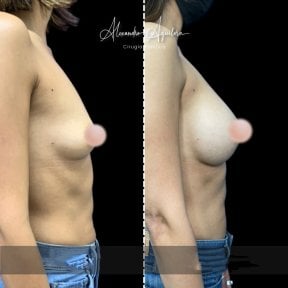 Результаты увеличения груди до и после в клинике Alexandre Aguilera, увеличенный объем