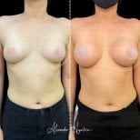 نتائج تكبير الثدي قبل وبعد – زيادة الحجم وتحسين شكل الثدي