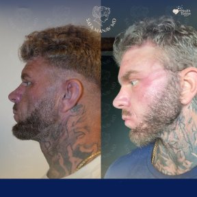 Vorher-nachher-Ergebnis Brauenlifting bei Dr. Safa Manav Clinic, sichtbare Stirnanhebung