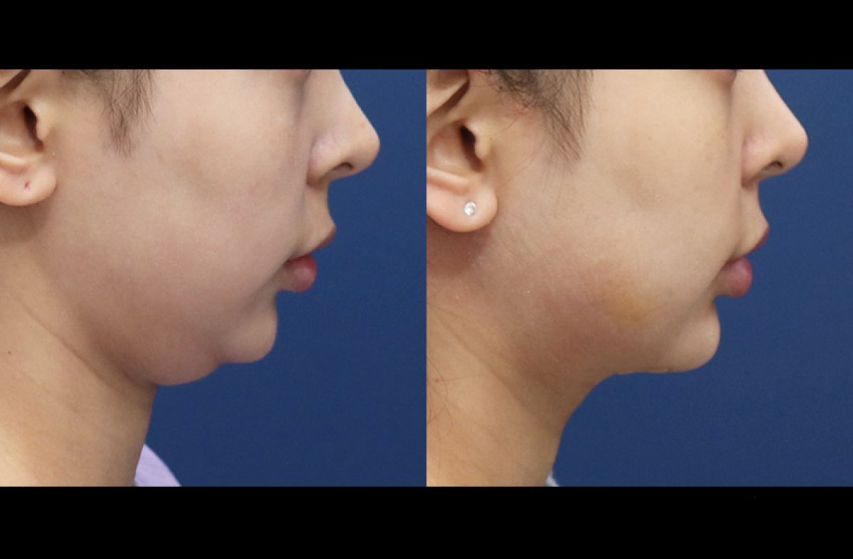Resultados de lifting de cuello antes y después en HERSHE Plastic Surgery Korea, contorno mejorado