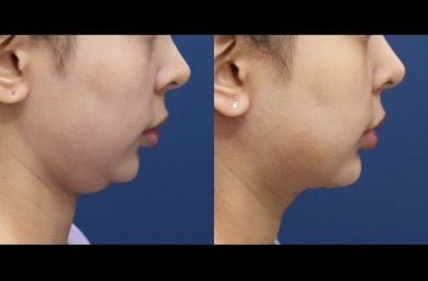 نتائج شد الرقبة قبل وبعد في HERSHE Plastic Surgery Korea، تحديد الفك المحسن