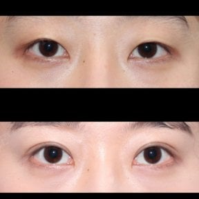 Efekty blefaroplastyki przed i po w HERSHE Plastic Surgery Korea, korekta powiek