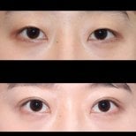 Efekty blefaroplastyki przed i po w HERSHE Plastic Surgery Korea, korekta powiek