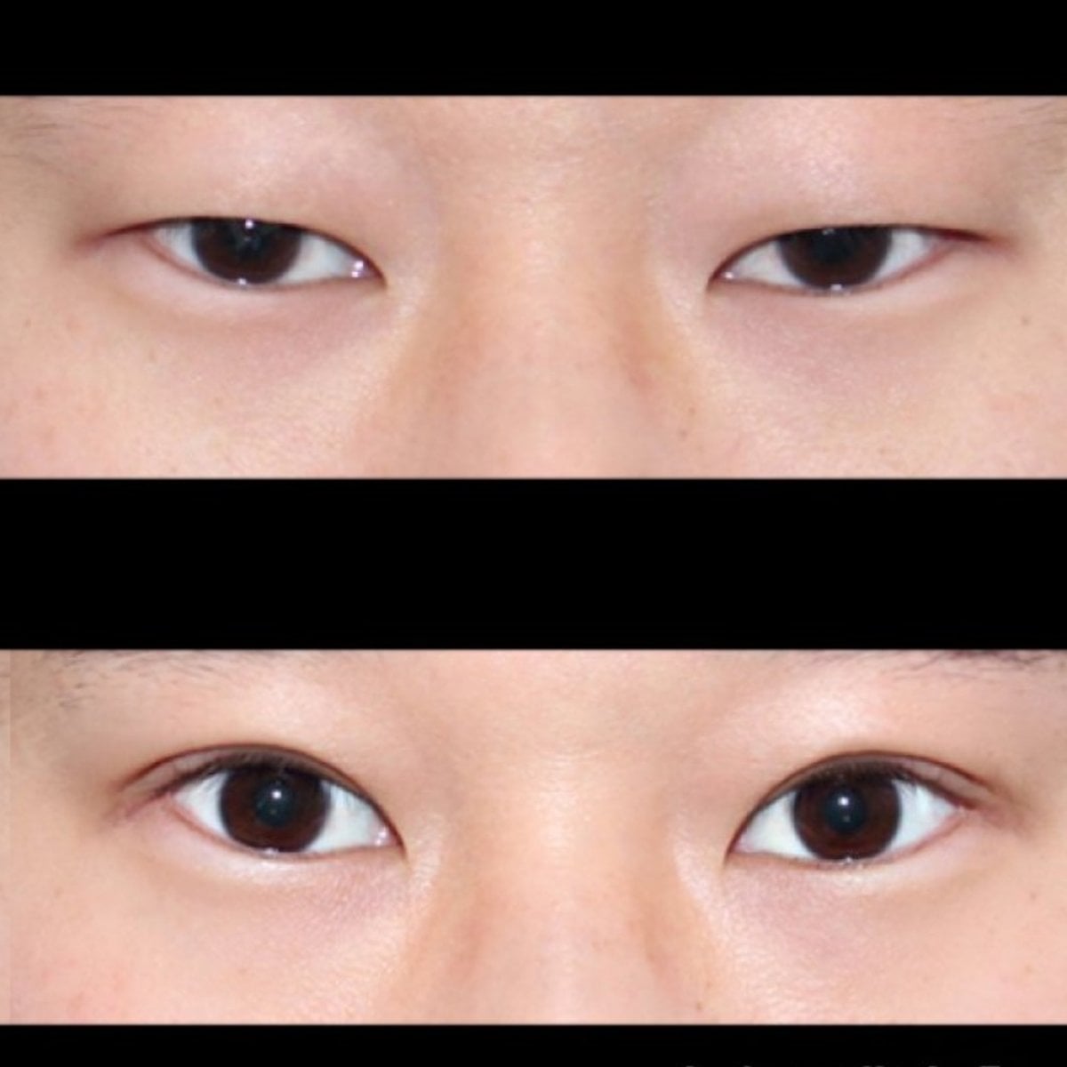 نتائج رأب الجفن قبل وبعد في HERSHE Plastic Surgery Korea، تصحيح الجفون