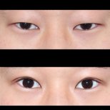 Результаты блефаропластики до и после в HERSHE Plastic Surgery Korea, коррекция век