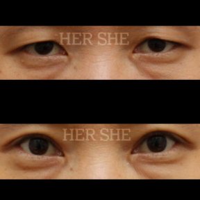 Résultats avant/après blépharoplastie chez HERSHE Plastic Surgery Korea, correction des paupières