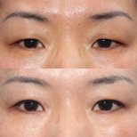 Résultats avant/après blépharoplastie chez HERSHE Plastic Surgery Korea, correction des paupières