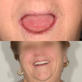 Before and after All-on-4 dental implants result – full smile restoration for missing teeth