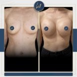 Before and after mammoplasty results at Medipol Acibadem District Hospital, breast augmentation