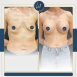 Before and after mammoplasty results at Medipol Acibadem District Hospital, breast augmentation