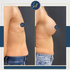 Before and after mammoplasty results at Medipol Acibadem District Hospital, breast augmentation