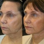 Before and after brow lift results at Memorial Şişli Hospital, visible eyebrow and forehead lift