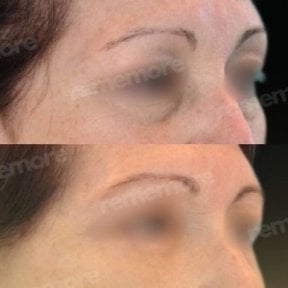 Before and after brow lift results at Memorial Şişli Hospital, visible eyebrow lift improvement
