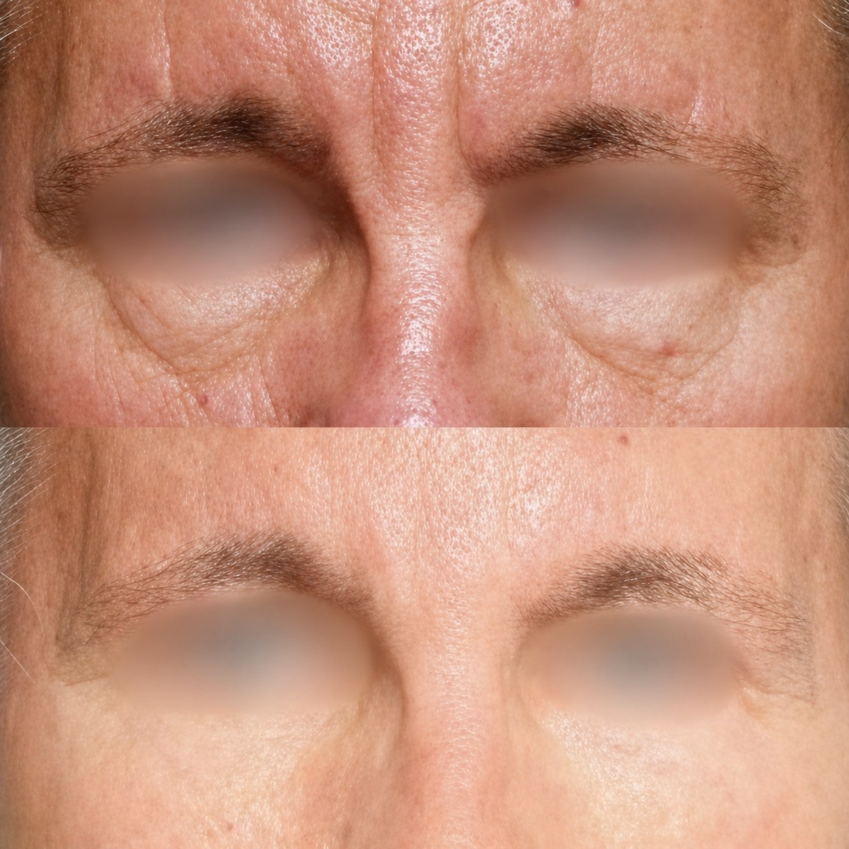 Resultados antes y después de lifting de cejas en Memorial Şişli Hospital, frente más lisa