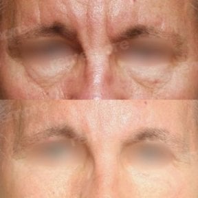 Before and after brow lift results at Memorial Şişli Hospital, smoother forehead and lifted brows