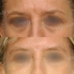 Before and after brow lift results at Memorial Şişli Hospital, visible eyebrow lift improvement