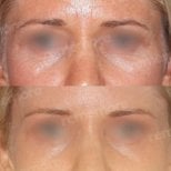 Before and after brow lift results at Memorial Şişli Hospital, smoother forehead and lifted brows