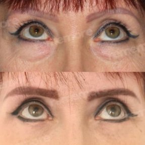 Résultats avant/après blépharoplastie à Memorial Şişli Hospital, correction des paupières