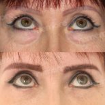 Résultats avant/après blépharoplastie à Memorial Şişli Hospital, correction des paupières