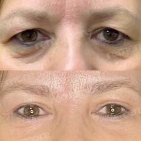 Résultats avant/après blépharoplastie à Memorial Şişli Hospital, correction des paupières