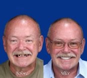 Resultados antes y después de implantes dentales All-on-4 – restauración total de sonrisa