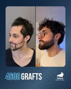 Результат пересадки бороды 4600 графтов до и после в Smile Hair Clinic
