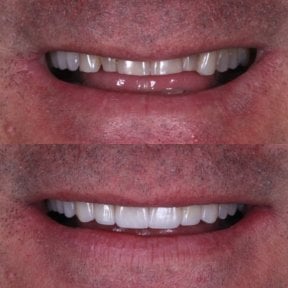 Vorher-nachher-Ergebnis Porzellanveneers – schönere, weißere Zähne und verbesserte Ästhetik