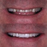 Vorher-nachher-Ergebnis Porzellanveneers – schönere, weißere Zähne und verbesserte Ästhetik