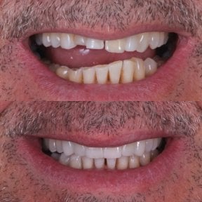 Resultados antes y después de implantes dentales All-on-4: sonrisa y dientes restaurados