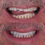 Resultados antes y después de implantes dentales All-on-4: sonrisa y dientes restaurados