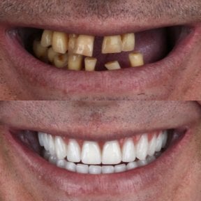Resultado antes y después de implantes dentales All-on-4: restauración total de la sonrisa