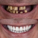 Resultado antes y después de implantes dentales All-on-4: restauración total de la sonrisa