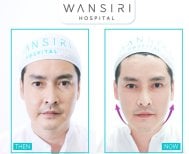 До и после инъекций ботокса в Wansiri Hospital – видимый результат улучшения контура лица
