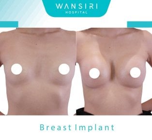 Résultats avant/après augmentation mammaire à Wansiri Hospital, volume des seins accru