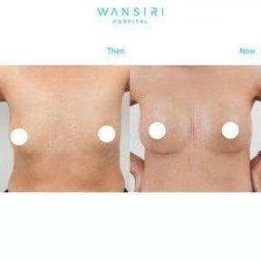 Résultats avant et après augmentation mammaire à Wansiri Hospital, amélioration visible