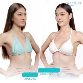 Avant et après augmentation mammaire à Wansiri Hospital, résultat volume accru